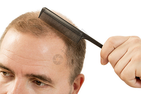 Alopecia 人毛发脱落秃顶疾病损失护理男性皮肤发型移植药品胡须背景图片