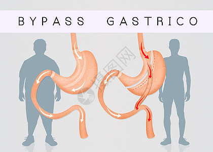 减少胃部的胃道切除术保健插图减肥男人肥胖卫生外科肠子器官饮食图片