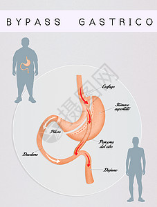 肠胃绕行器官卫生减肥插图饮食肠子手术外科男人男性图片
