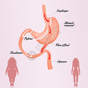 肠胃绕行保健器官卫生肥胖减肥女性饮食插图外科女士图片