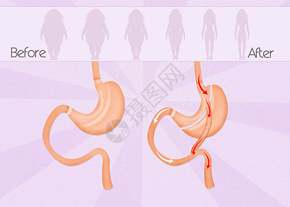 在胃外科手术前后和之后肥胖女士器官饮食减肥保健女性卫生插图肠子图片