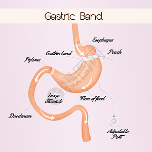 减少胃胃部的胃道带保健器官可调外科肠子插图减肥肥胖卫生乐队图片