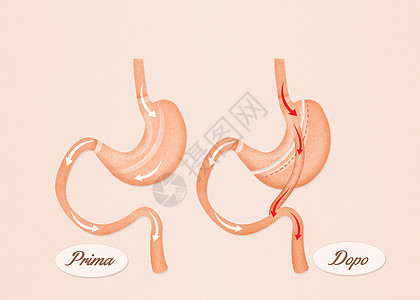 肠胃外科手术饮食器官保健减肥肥胖卫生插图肠子图片
