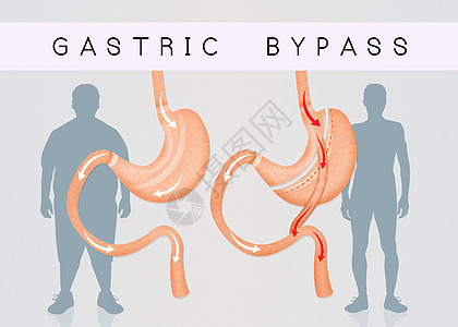在胃外科手术前后和之后肠子插图保健男人饮食男性卫生肥胖器官减肥图片