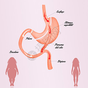 减少胃部的胃道切除术饮食手术外科肠子保健卫生女士插图女性减肥图片