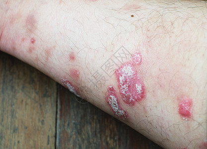 丝虫病宏观药品疾病弯头发痒病人医疗皮肤手臂皮炎图片