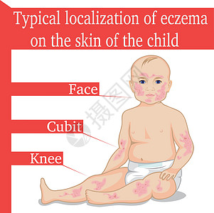 儿童用食血(Eczema)图片