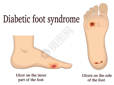 糖尿病足综合症图片
