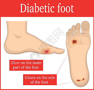 治疗伤口糖尿病足设计图片