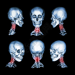 颅骨和颈部的 CT 扫描和 3D 图像 将此图像用于颈椎病 脊椎滑脱 脊椎炎 脊柱外伤情况疼痛男人肌肉创伤骨科外科椎骨脖子骨骼解图片