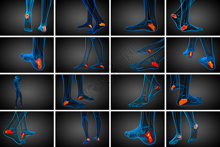 3d 医学上展示了大口径的骨骼病人创伤跟骨医疗痛风3d风湿渲染痛苦骨科图片