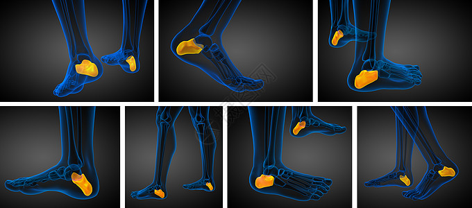 3d 医学上展示了大口径的骨骼风湿痛风渲染3d创伤医疗痛苦骨科跟骨病人图片