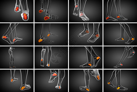 3d 医学上展示了大口径的骨骼3d痛风风湿痛苦跟骨创伤病人骨科渲染医疗图片