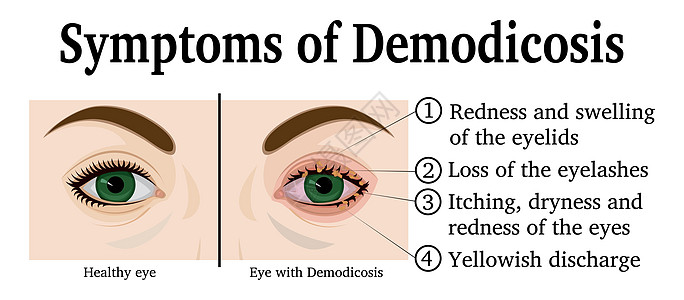 Demodicosi 的插图图片