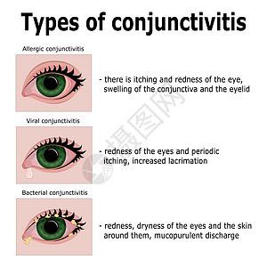结膜性炎类型图片