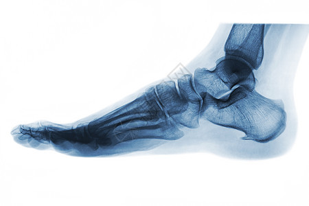 X射线正常人脚 横向视图 反向颜色样式放射科药品骨科脚跟脚趾创伤科学蓝色男人扫描图片