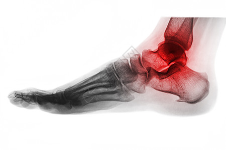 板烧鸡腿堡脚踝关节炎 脚部X光片 横向视图 反颜色风格跟骨跗骨创伤扫描x射线骨骼病人放射科骨科痛风背景