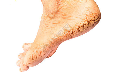 妇女穿高跟鞋 白底 脚健康概念玉米皮肤脚跟修脚医生卫生女性赤脚皮肤科身体背景图片