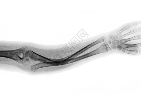 AP显示脉轮骨骨折断轴畸形现金男人手臂创伤外科疾病事故手腕手术图片