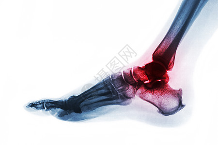 脚踝关节炎 足部X光片 横向视图 反向颜色风格 Gout 或风湿概念扫描疼痛发炎跗骨放射科骨骼x射线病人电影蓝色图片