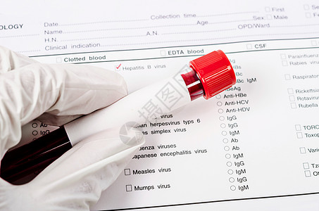 用于肝炎检测的手持血管微生物学血液学免疫学化学微生物病人发烧黄疸生物技术图片