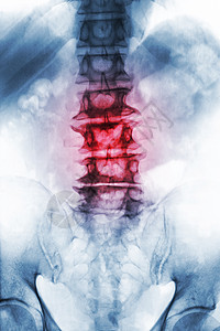 老年病人的薄膜X射线 lumbosacal脊椎显示骨质疏松 从降解过程中折断脊椎 Front View整骨衰老骶骨脊柱扭伤疾病骨图片