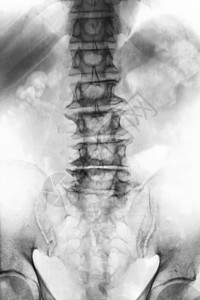 老年病人的薄膜X射线 lumbosacal脊椎显示骨质疏松 从降解过程中折断脊椎 Front View解剖学腰椎骨盆骨干脊柱衰老图片