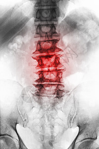 老年病人的薄膜X射线 lumbosacal脊椎显示骨质疏松 从降解过程中折断脊椎 Front View骨科x光外科扫描x射线腰椎图片