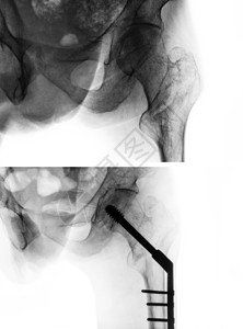 转子间骨折股骨 大腿骨 髋关节 X 光片以及手术前 上图 和手术后 下图 的比较 患者接受手术并插入髓内钉射线创伤治疗外科男人骨图片