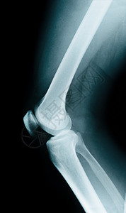 膝骨解剖图片