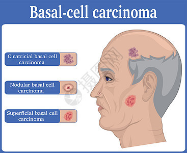 Basal细胞癌的插图图片