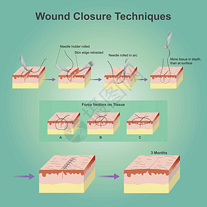 伤口结扎技术生物学粉刺疾病皮肤身体解剖学跌倒头发疙瘩真皮图片
