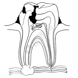 牙齿断了和龋齿解剖医学概念-矢量说明图片