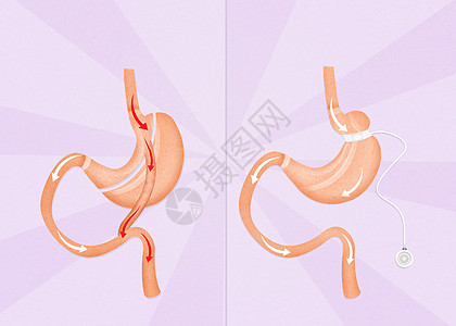 肠胃外科手术和腹腔带外科手术图片
