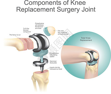 膝关节置换手术关节的组成部分 卫生保健 人体解剖学图片