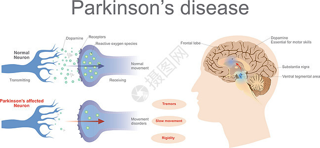 帕金森病神经步态弱点减值演讲运动细胞电极皮层恶化图片