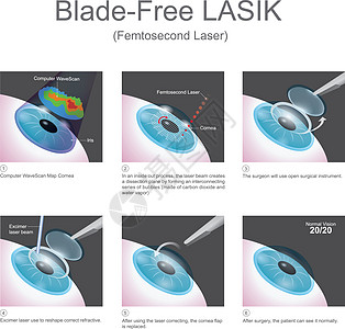 无刀的LASIK图片