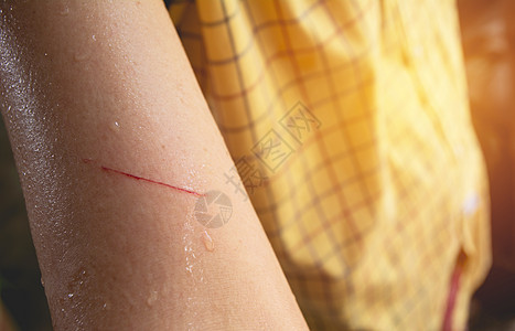 妇女手臂被钢丝划伤 表示有伤感图片