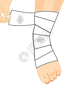 绷带中腿部身体帮助扭伤绝缘疼痛手指插图药品石膏白色图片