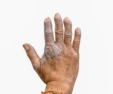 隔离在白种背景 皮肤病和皮肤衰竭的农民手中的丝虫病近距离特写 而Psoralpic手指畸形图片