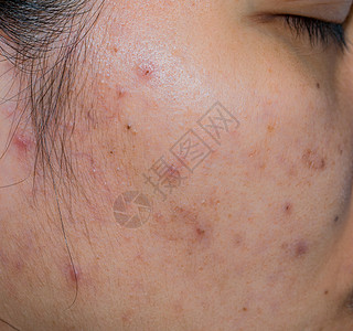 亚裔妇女油状脸皮上的Acne和acne斑点 在治疗肾上腺素之前构想 并面对激光处理 以摆脱阴后肝脏的黑点图片
