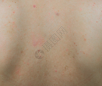 后背有红斑和黑棕色斑点 在妇女背部皮肤上图片