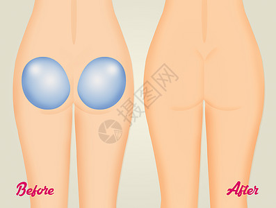 在臀部改造之前和之后高清图片