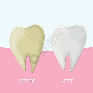 专业牙齿白牙 健康与黄牙 矢量图解临床药品矫正衰变卫生口腔科治疗牙膏磨牙口服图片