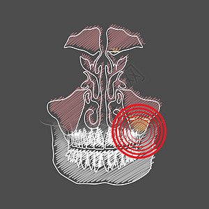 牙源性鼻窦炎的程式化孵化 由于牙根疾病引起的上颌窦炎症 伴有疼痛和炎症图片