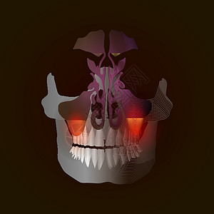 从真实图像到带有疼痛和炎症点的线性 X 射线效果的过渡 牙源性鼻窦炎 由于牙根疾病引起的上颌窦炎症 伴有疼痛和炎症图片