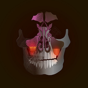 从真实图像到带有疼痛和炎症点的点 X 射线效果的过渡 牙源性鼻窦炎 由于牙根疾病引起的上颌窦炎症 伴有疼痛和炎症图片