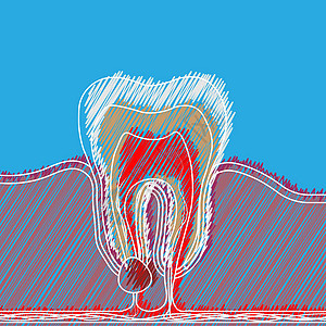 具有疼痛和炎症的牙科疾病时态孵化 牙根炎 牙根细胞 软骨炎等医学说明; “脑膜炎”图片
