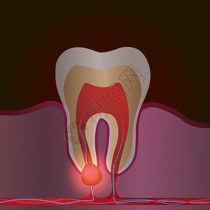 伴有疼痛和炎症的牙科疾病 牙根炎症牙根囊性牙髓炎的医学插图图片