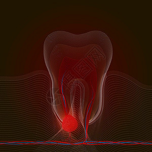 点造型用点痛点发炎 牙根炎症 牙根囊肿 牙髓炎的医学插图 X射线效应图片